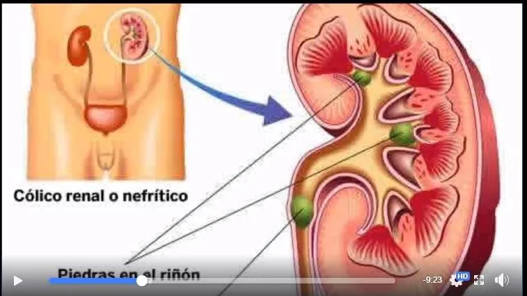 Visita de médico sobre los cálculos renales